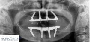 All on 4 implants 300x140